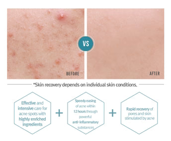 Pyunkang Yul - Crema antiacné Acne Spot Cream 15 ml