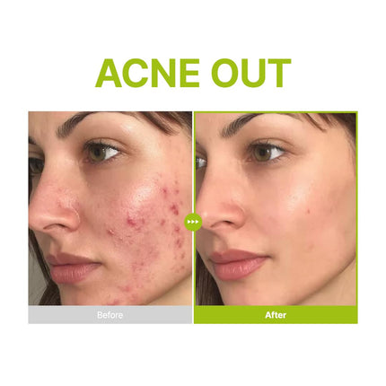 Purito Azelaic Acid 10 Kojic Tea Tree Serum 30ml