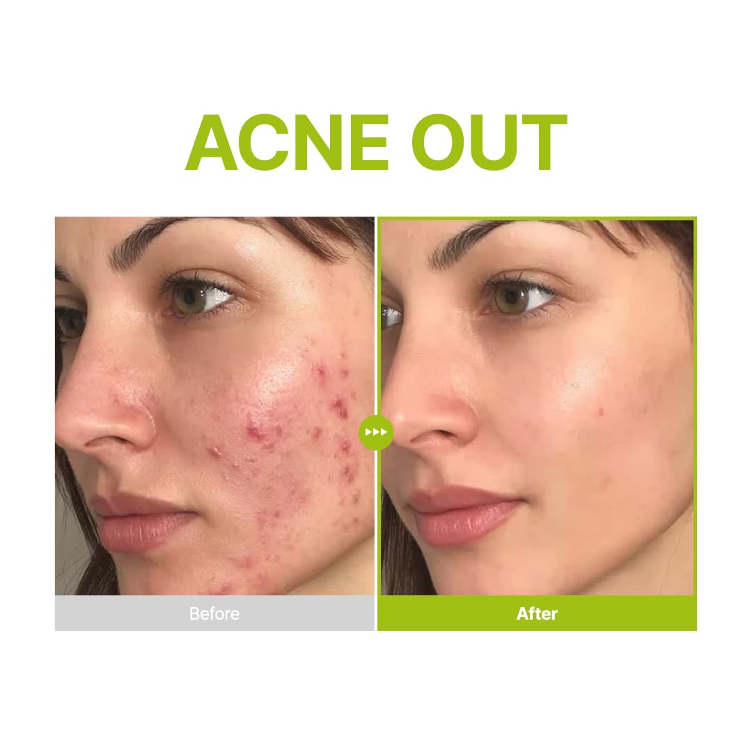 Purito Azelaic Acid 10 Kojic Tea Tree Serum 30ml
