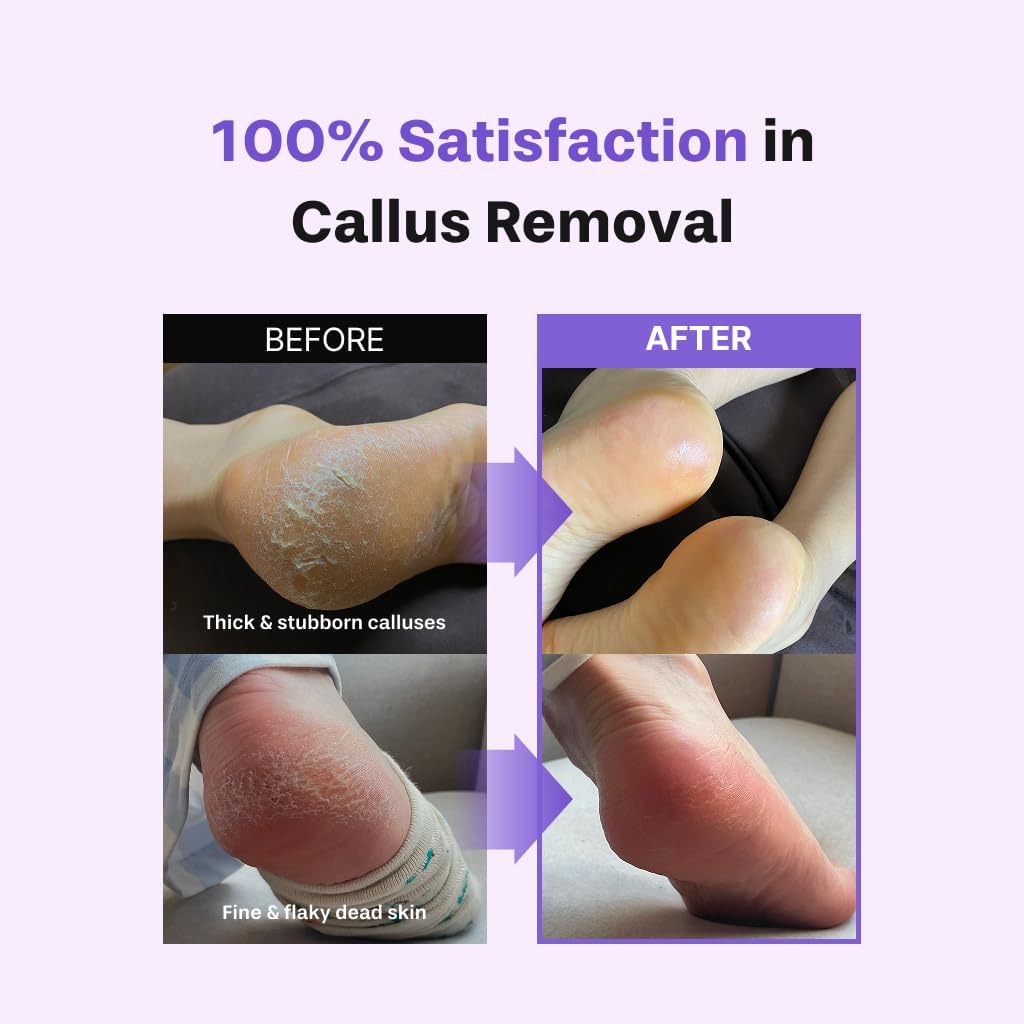 Baren Foot Callus Remover Kit – Kit Removedor de Callos para Pies (Spray Exfoliante + Lima de Acero Inoxidable)