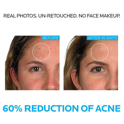 La Roche Posay Tratamiento dermatológico del acné Effaclar