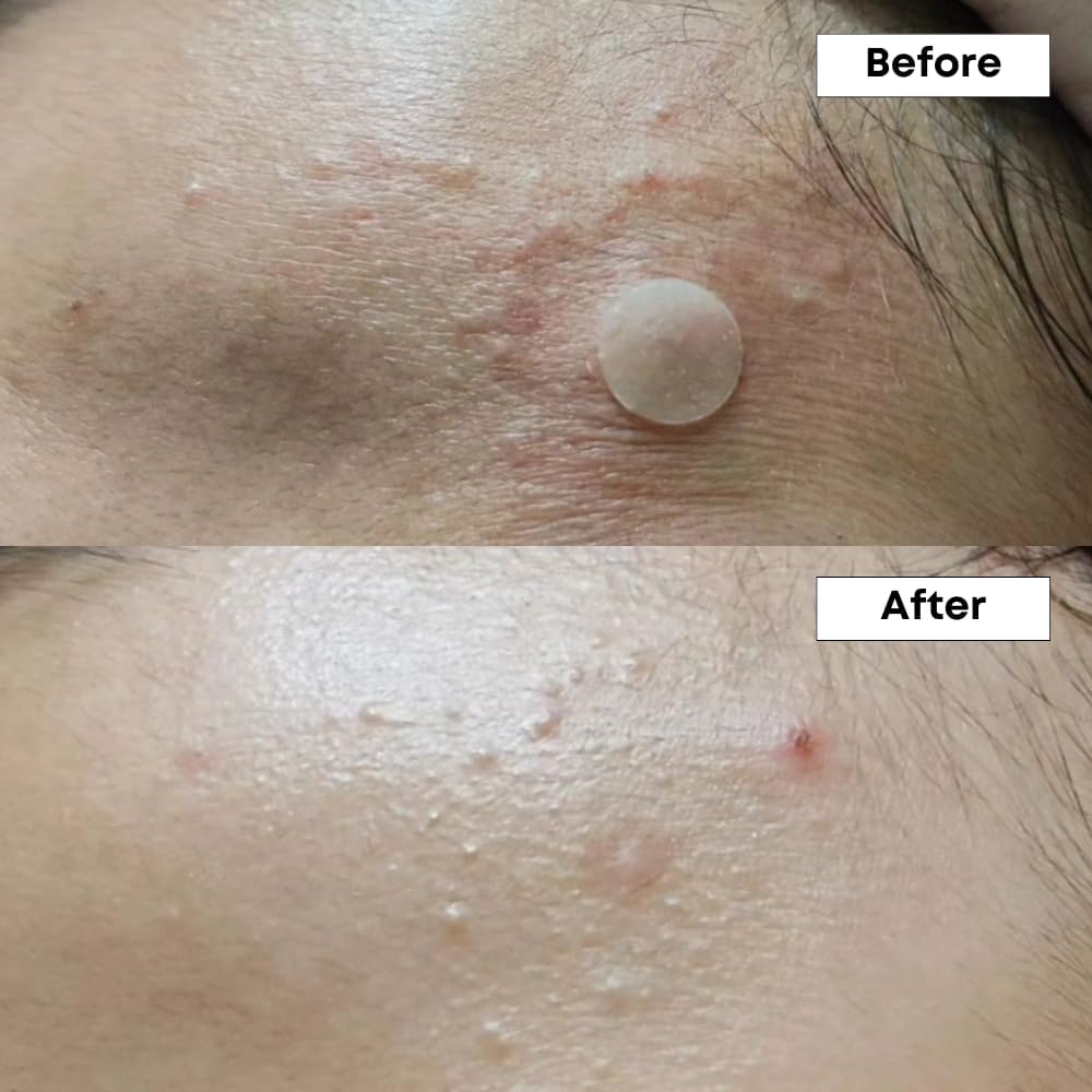 Nine Less Azelaic Acid Serum Duo Set (Free Gift : Azelaic Acid Cream 15ml (2ea)