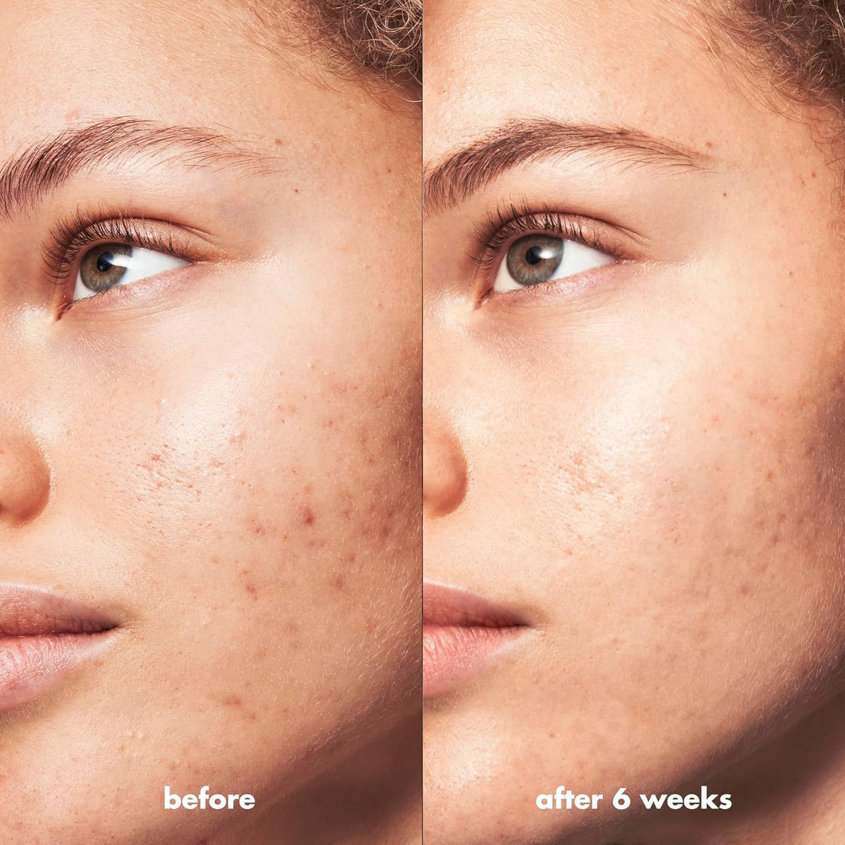 e.l.f. SKIN Blemish Breakthrough - 50ml Crema calmante y ligera, que combate las imperfecciones