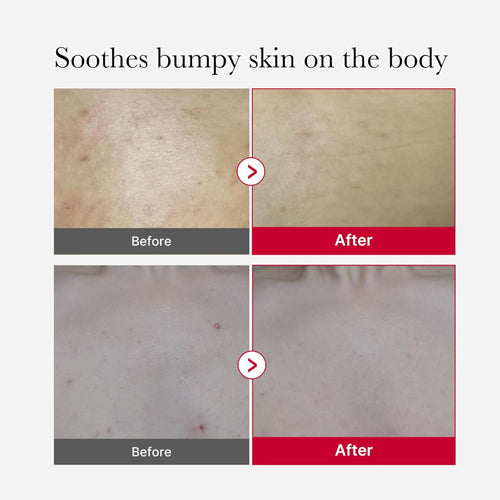 Medicube Red Acne Body Peeling Shot – 110g