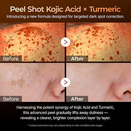 Dr.Melaxin Peel Shot Exfoliating Kojic Acid Turmeric Serum 80ml