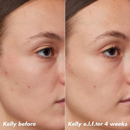 e.l.f. PLZ Clarify Facial Oil - 2% Salicylic Acid Acne Treatment + Aloe Extract 30ml