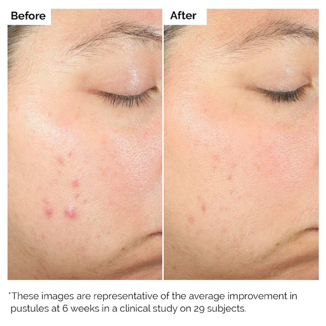 The Ordinary Acido Salicilico 2% Solution |Tratamiento Ácido Salicílico